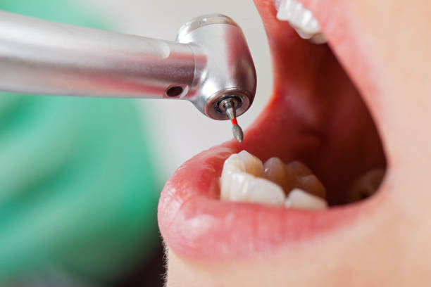 Best Dentist for Tooth Abscess  in Tillmans Corner, AL